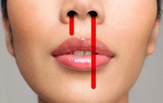 خونریزی بینی