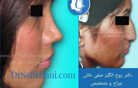 قبل و بعد از عمل بینی
