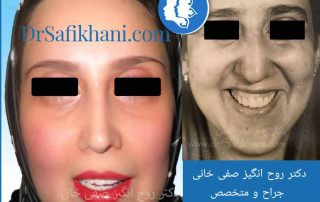 قبل و بعد از عمل بینی 