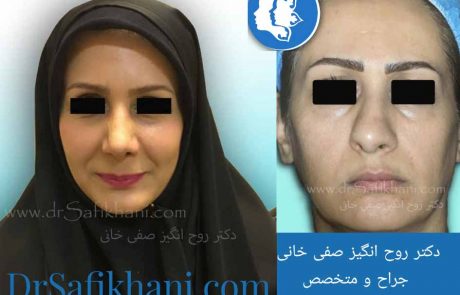 قبل و بعد از عمل بینی