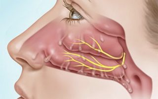 رینیت آلرژیک