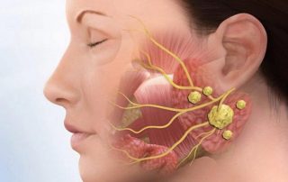 سنگ غده بزاقی