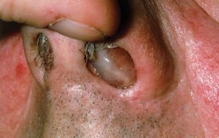 پولیپ بینی و سینوس