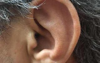 عفونت گوش خارجی