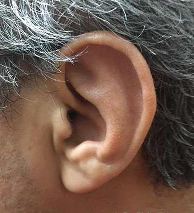 عفونت گوش خارجی