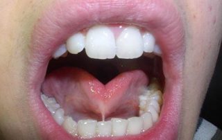 چسبندگی زبان در دهان