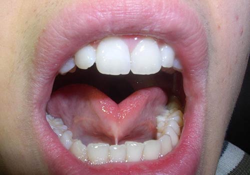 چسبندگی زبان در دهان