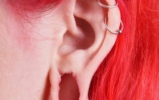 پارگی نرمه گوش