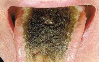 زبان پرزدار سیاه