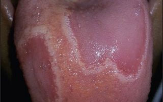 التهاب زبان