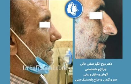 قبل و بعد از عمل بینی مردانه