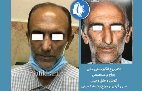قبل و بعد از عمل بینی مردانه