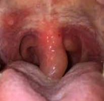 التهاب زبان کوچک