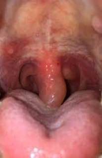 التهاب زبان کوچک